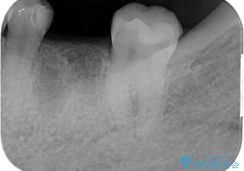 欠損部のインプラント補綴の治療前