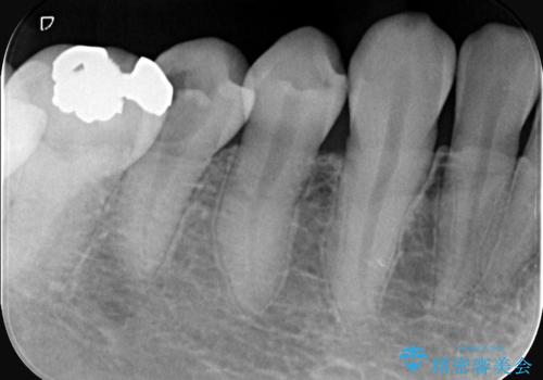 虫歯治療|歯を長持ちさせるための治療|セラミッククラウン|審美回復|精密根管治療の治療前