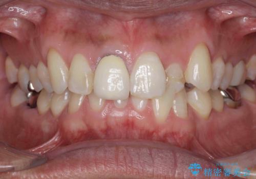 奥に引っ込んでいる前歯を並べたい 矯正治療とセラミック治療の治療前