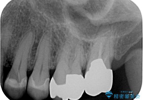 銀歯が取れた　セラミックインレー修復の治療後