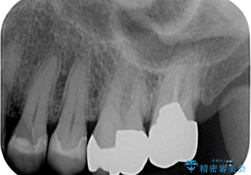 銀歯が取れた セラミックインレー修復の治療後