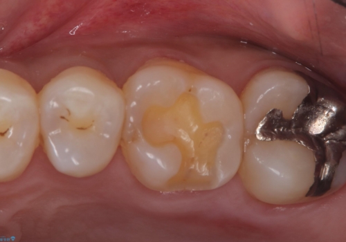 【セラミックインレー】銀の詰め物が外れてしまったの治療中