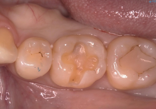 【セラミックインレー】プラスチックの劣化が気になるの治療中