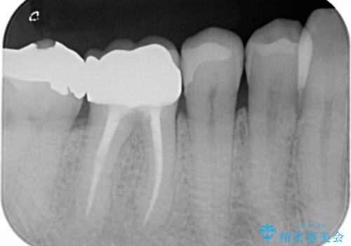 保険材料をセラミックにやり変えたい セラミックインレーの治療後