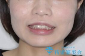 部分矯正で前歯をなおしたい→全顎ワイヤー矯正できちんと治すの治療前(顔貌)