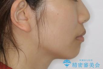 下顎前歯の先天欠損と上顎前歯のクロスバイト:インビザライン治療の治療後(顔貌)