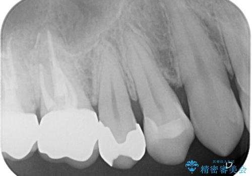 他院のセラミックインレー やり直し治療の治療後