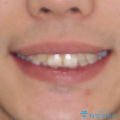 深い咬み合わせと前歯のデコボコ ワイヤー装置での抜歯矯正の治療前(顔貌)