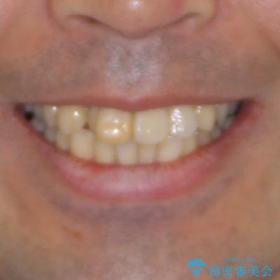 隠れている前歯 インビザライン矯正治療と前歯のセラミック治療の治療前(顔貌)