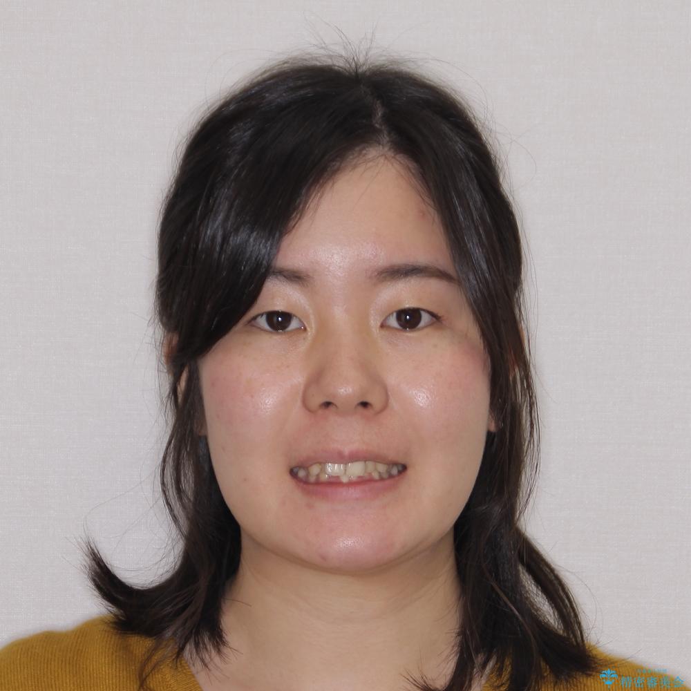 【モニター】デコボコ前歯を治したい ワイヤー装置での抜歯矯正治療の治療前(顔貌)