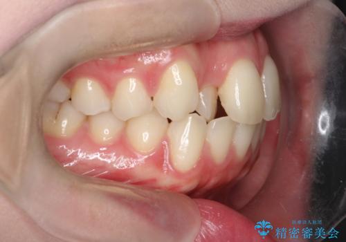上下4本の抜歯と審美ワイヤー矯正で整った歯並びへの治療前
