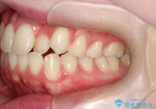 上下4本の抜歯と審美ワイヤー矯正で整った歯並びへの治療前
