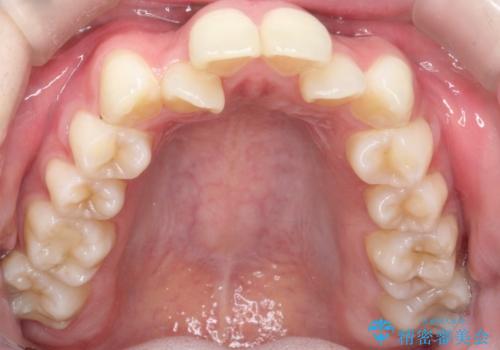 上下4本の抜歯と審美ワイヤー矯正で整った歯並びへの治療前