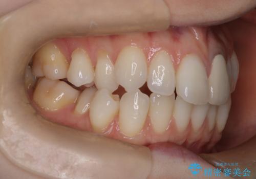 ハーフリンガル矯正|上下4本の抜歯で叢生を改善し、美しい歯並びへの治療前