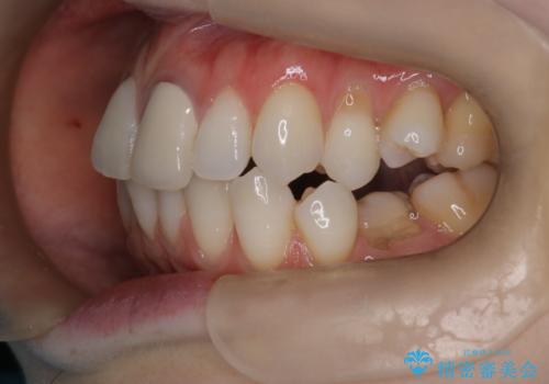 ハーフリンガル矯正|上下4本の抜歯で叢生を改善し、美しい歯並びへの治療前