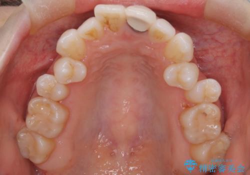 ハーフリンガル矯正|上下4本の抜歯で叢生を改善し、美しい歯並びへの治療前