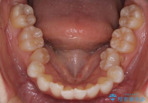 ハーフリンガル矯正|上下4本の抜歯で叢生を改善し、美しい歯並びへの治療前