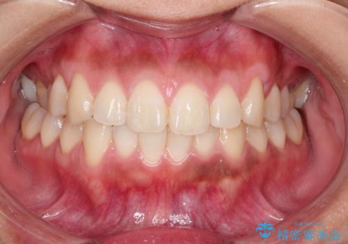 臼歯部の反対咬合を改善|MARPEによる上顎急速拡大+審美ワイヤー矯正の症例 治療前