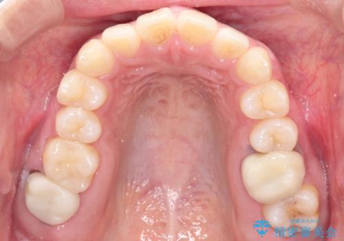 臼歯部の反対咬合を改善|MARPEによる上顎急速拡大+審美ワイヤー矯正の治療前