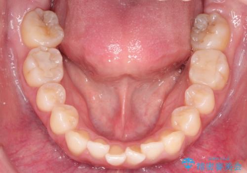 臼歯部の反対咬合を改善|MARPEによる上顎急速拡大+審美ワイヤー矯正の治療前