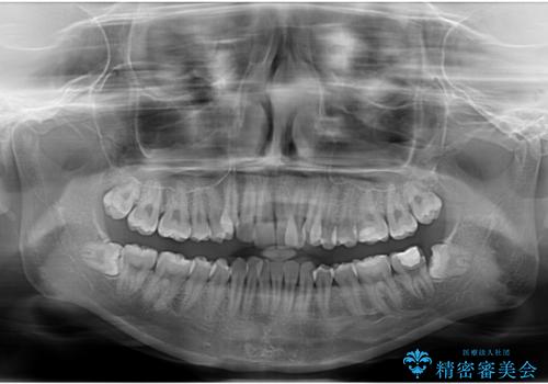 八重歯が気になる。補助装置を併用したワイヤー矯正の治療前