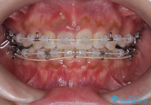 前歯の突出感を改善|上下4本の抜歯と審美ワイヤー矯正でバランスの取れた口元への治療中