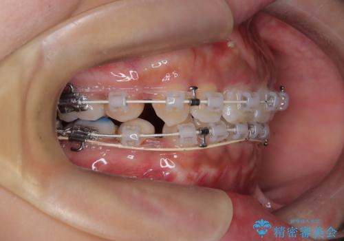 前歯の突出感を改善|上下4本の抜歯と審美ワイヤー矯正でバランスの取れた口元への治療中