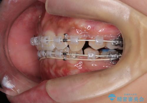 前歯の突出感を改善|上下4本の抜歯と審美ワイヤー矯正でバランスの取れた口元への治療中