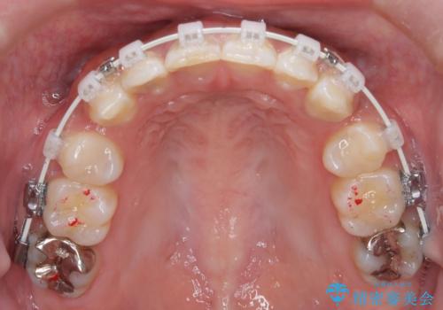 前歯の突出感を改善|上下4本の抜歯と審美ワイヤー矯正でバランスの取れた口元への治療中