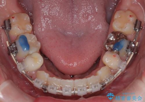 前歯の突出感を改善|上下4本の抜歯と審美ワイヤー矯正でバランスの取れた口元への治療中