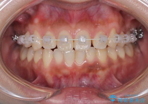 臼歯部の反対咬合を改善|MARPEによる上顎急速拡大+審美ワイヤー矯正の治療中