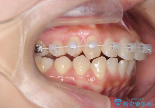 臼歯部の反対咬合を改善|MARPEによる上顎急速拡大+審美ワイヤー矯正の治療中