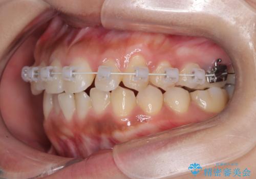 臼歯部の反対咬合を改善|MARPEによる上顎急速拡大+審美ワイヤー矯正の治療中