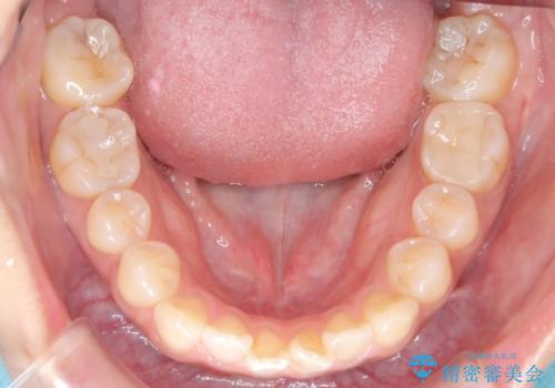 臼歯部の反対咬合を改善|MARPEによる上顎急速拡大+審美ワイヤー矯正の治療中