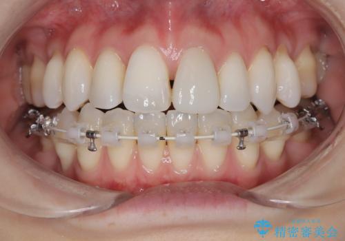 ハーフリンガル矯正|上下4本の抜歯で叢生を改善し、美しい歯並びへの治療中