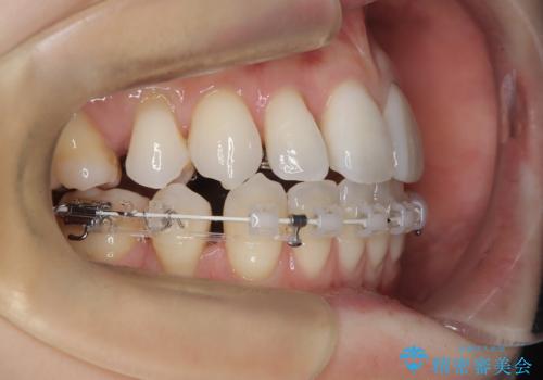 ハーフリンガル矯正|上下4本の抜歯で叢生を改善し、美しい歯並びへの治療中