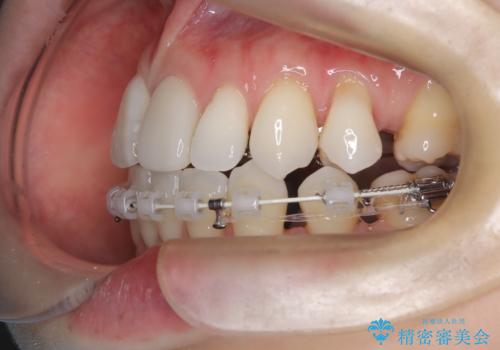 ハーフリンガル矯正|上下4本の抜歯で叢生を改善し、美しい歯並びへの治療中