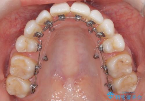 ハーフリンガル矯正|上下4本の抜歯で叢生を改善し、美しい歯並びへの治療中