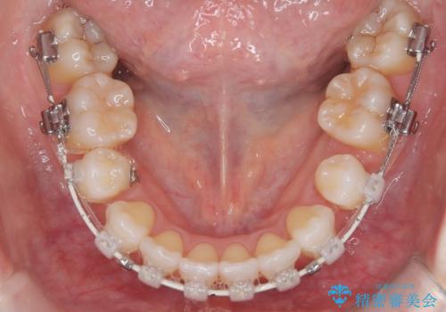 ハーフリンガル矯正|上下4本の抜歯で叢生を改善し、美しい歯並びへの治療中
