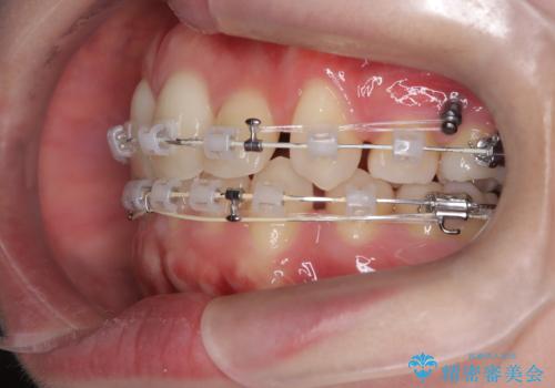 上下4本の抜歯と審美ワイヤー矯正で整った歯並びへの治療中