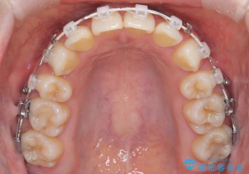 上下4本の抜歯と審美ワイヤー矯正で整った歯並びへの治療中