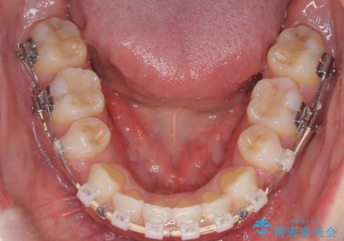 上下4本の抜歯と審美ワイヤー矯正で整った歯並びへの治療中