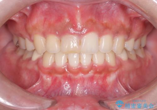 前歯の突出感を改善|上下4本の抜歯と審美ワイヤー矯正でバランスの取れた口元への治療後