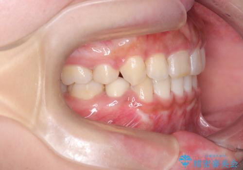 前歯の突出感を改善|上下4本の抜歯と審美ワイヤー矯正でバランスの取れた口元への治療後