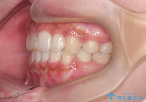 前歯の突出感を改善|上下4本の抜歯と審美ワイヤー矯正でバランスの取れた口元への治療後