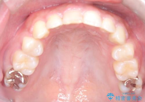 前歯の突出感を改善|上下4本の抜歯と審美ワイヤー矯正でバランスの取れた口元への治療後