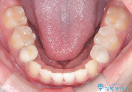 前歯の突出感を改善|上下4本の抜歯と審美ワイヤー矯正でバランスの取れた口元への治療後