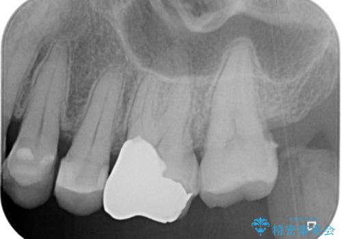 目立つ銀歯を白くしたい。オールセラミッククラウンによる補綴治療の治療前