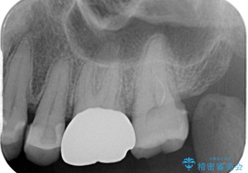 目立つ銀歯を白くしたい。オールセラミッククラウンによる補綴治療の治療後