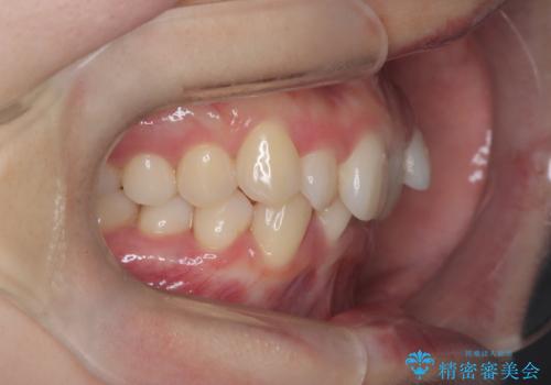 インビザライン矯正|下顎前歯1本抜歯でスムーズに歯列改善(1年で完了)の治療前